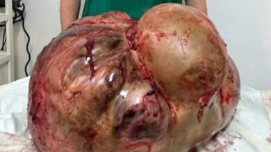 Photo of Médicos fazem cirurgia de emergência e retiram tumor de 46 kg de paciente em Itaperuna l Saúde l  BNRJ