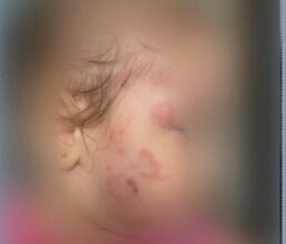 Photo of Bebê é agredida em creche, fica com vários hematomas e família alega omissão de socorro